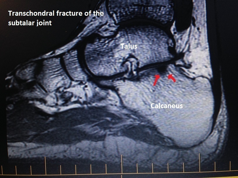transchondral fracture of the subtalar joint